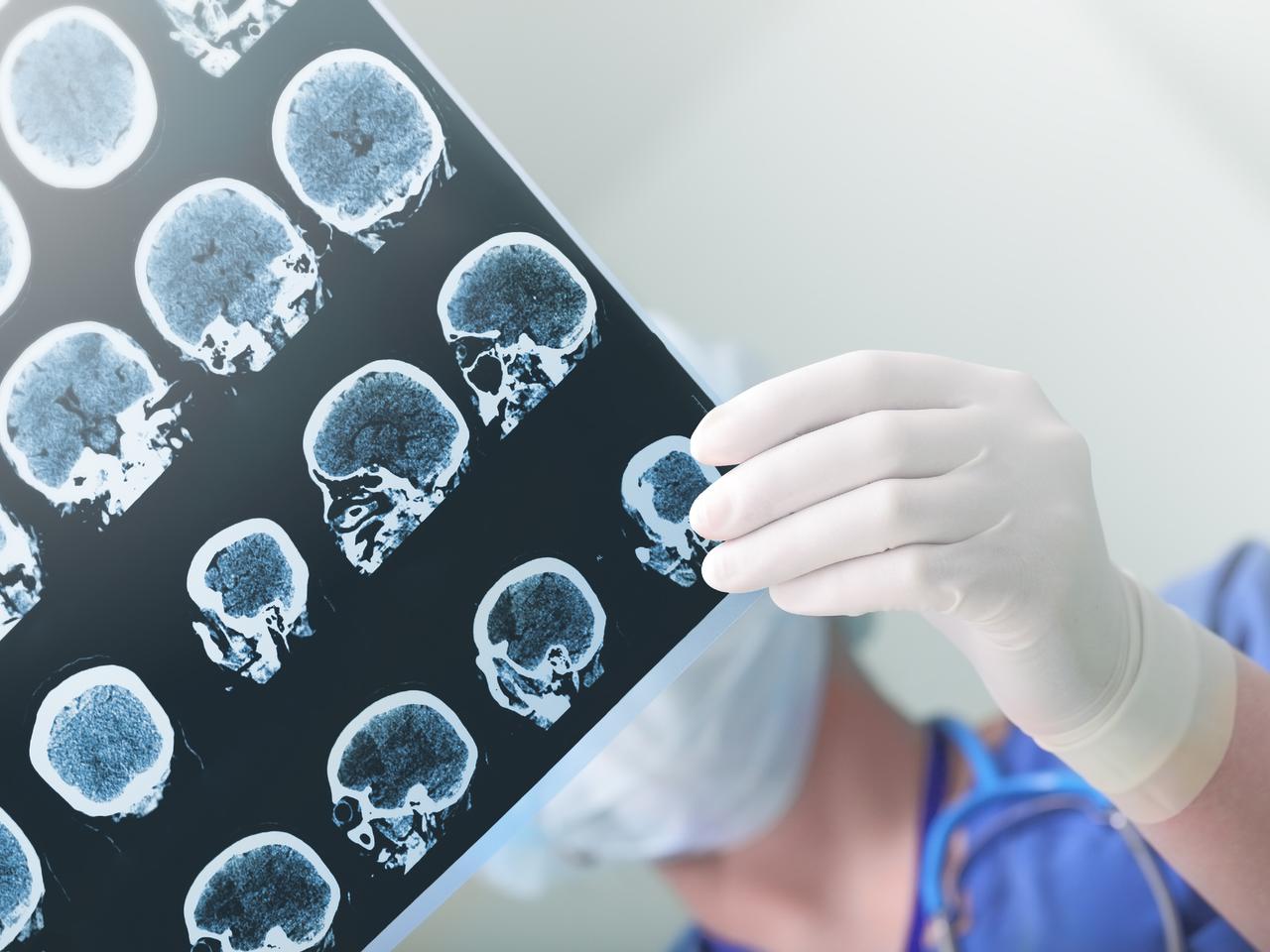 Choroby neurologiczne u dzieci. Jakie to choroby i jak się objawiają?