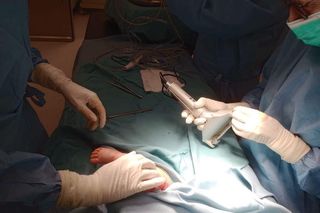 Mała dziewczynka po przeszczepie skóry