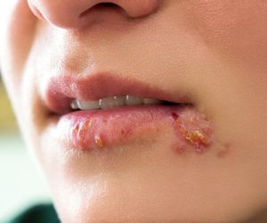 Opryszczka: przyczyny, objawy, leczenie