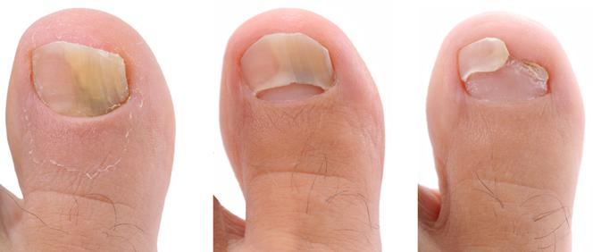 Leczenie grzybicy paznokci. Czy można leczyć grzybicę paznokci w domu?