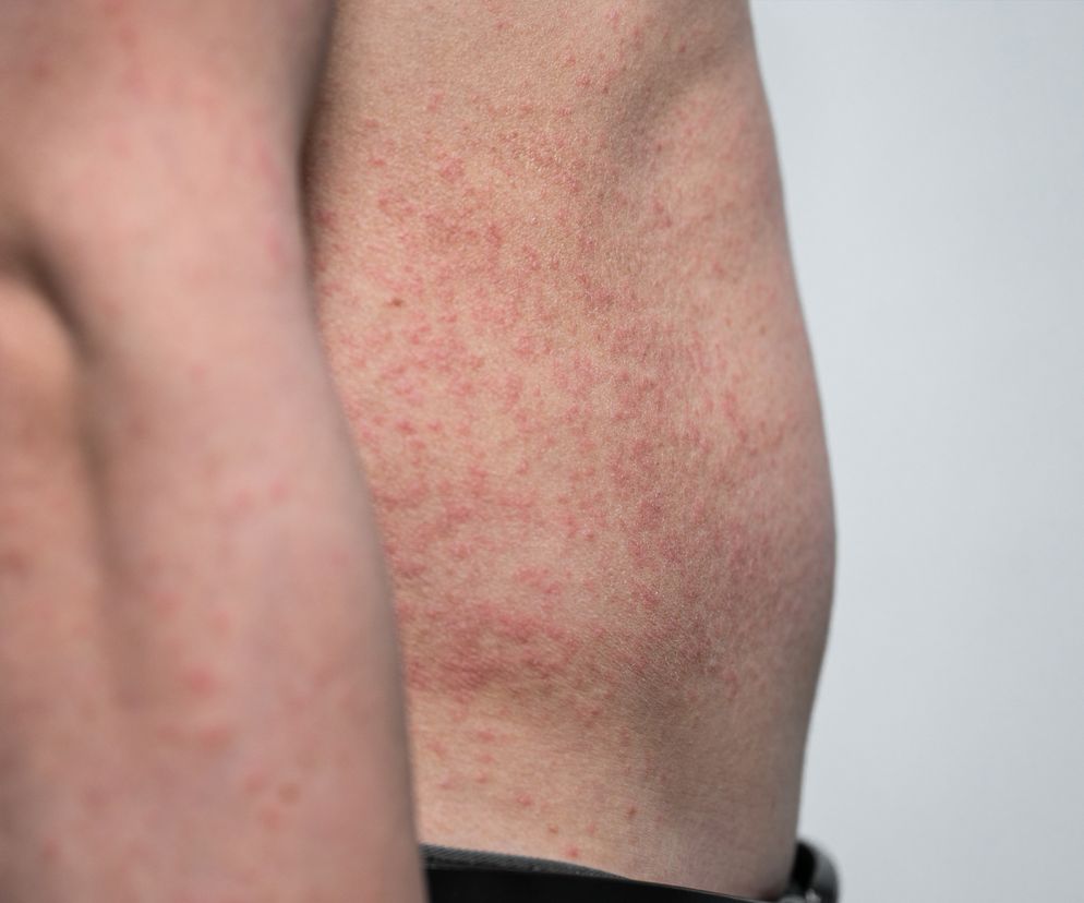 Tak wielu przypadków róży, zakaźnej choroby skóry, nie było u nas od dawna