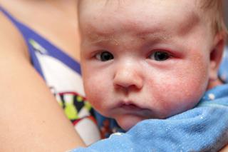 Pokrzywka u niemowlaka: przyczyny, objawy, leczenie
