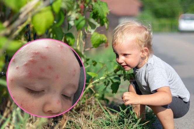 To tylko ukąszenia owadów? Te objawy powinny zaniepokoić rodzica 