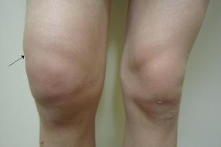 Woda w kolanie - jak rozpoznać objawy wysięku w stawie kolanowym?