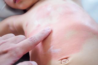 Kontaktowe zapalenie skóry - leczenie. Co wywołuje wyprysk kontaktowy?