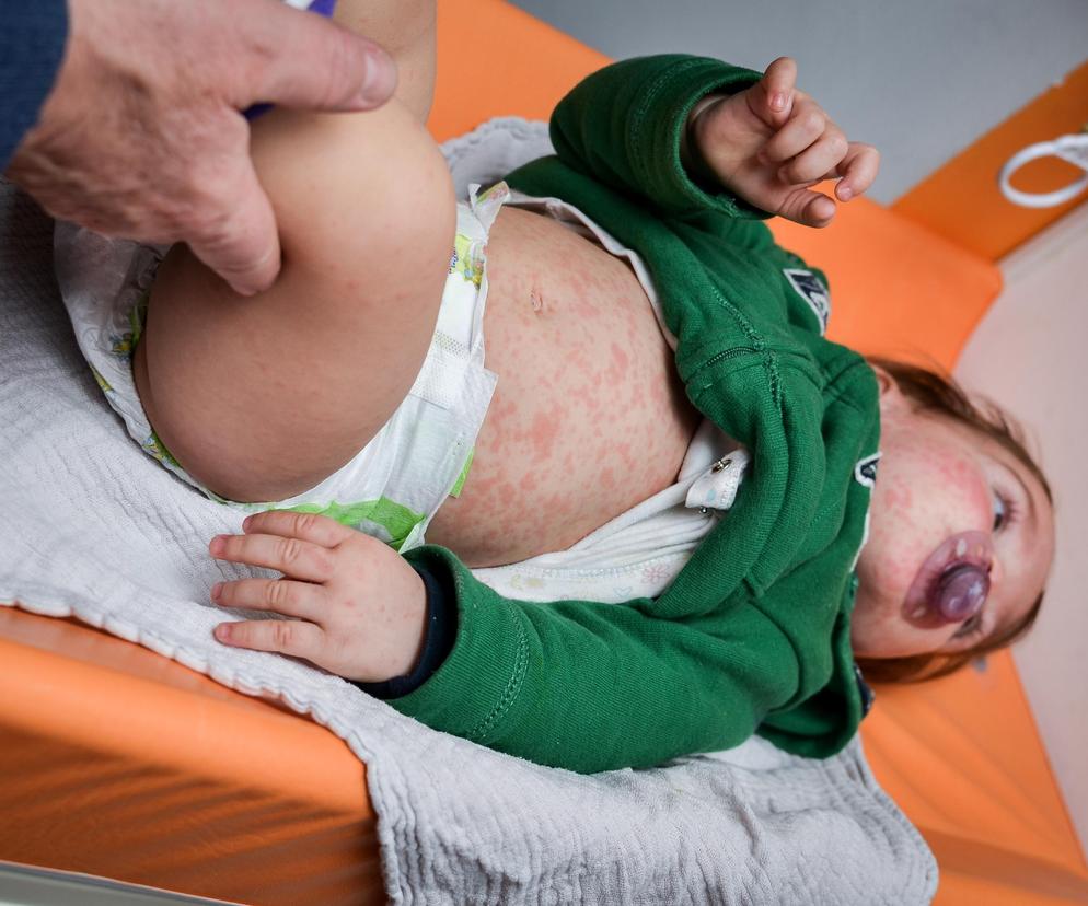 Liczba zakażeń odrą wzrosła 45-krotnie. WHO podnosi alarm w całej Europie