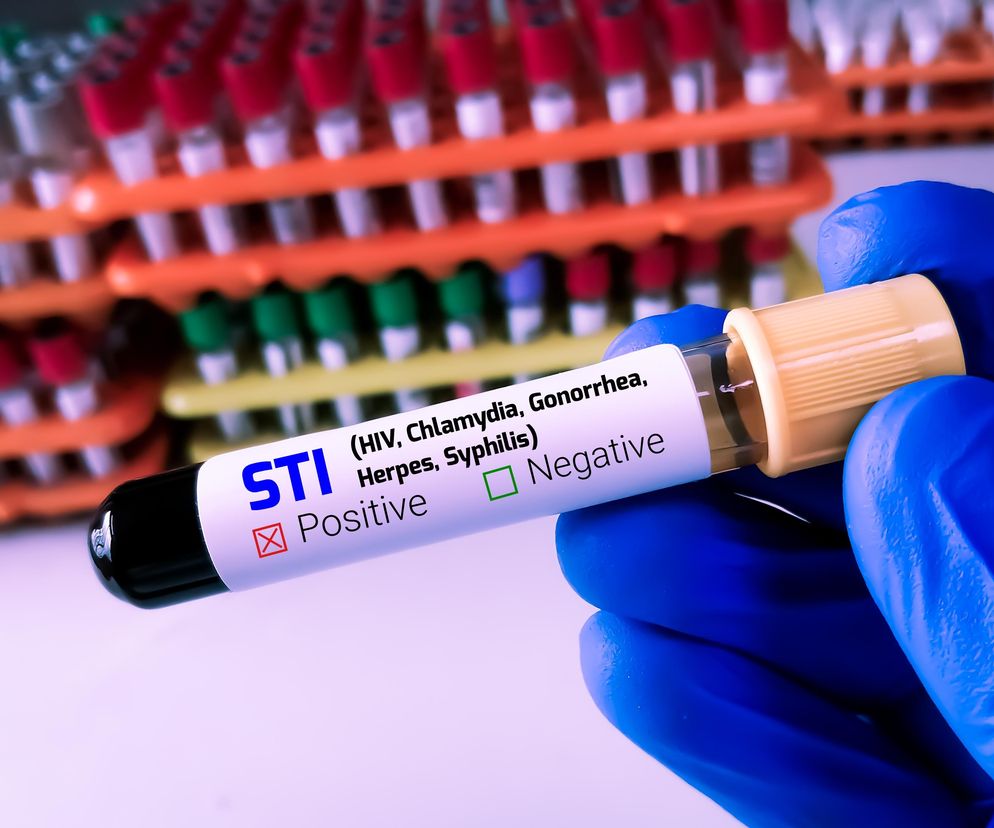 Dłoń w niebieskiej rękawiczce trzyma probówkę z wynikami testu na STI (HIV, Chlamydia, Gonorrhoea, Herpes, Syphilis), wskazującymi na wynik pozytywny. W tle widać stojak z innymi probówkami. Dowiedz się więcej o bezobjawowych chorobach wenerycznych na Poradnik Zdrowie.