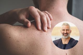 Dr Pawlikowski: Czerniak to mistrz kamuflażu