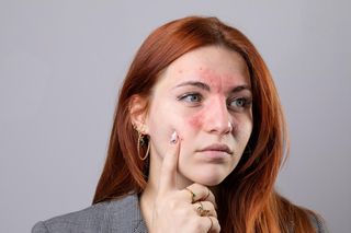Jedna z najbardziej podstępnych chorób. 10 maja obchodzimy Światowy Dzień Tocznia
