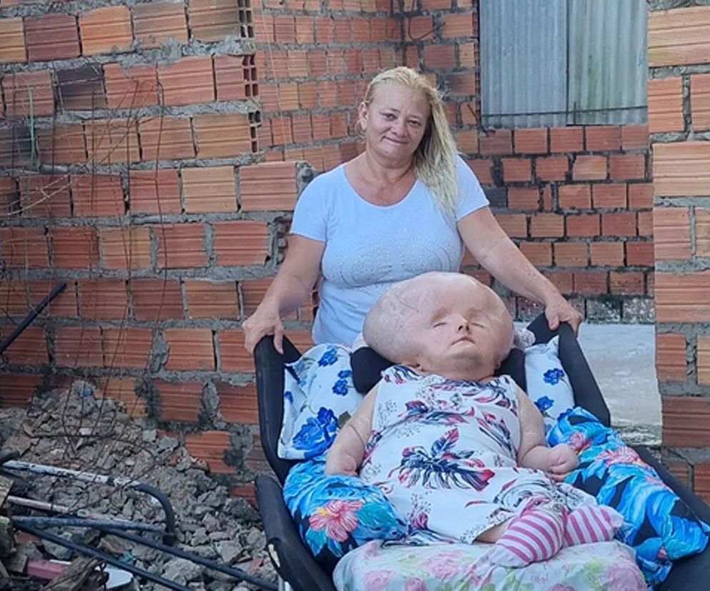 Nie miała żadnych szans, a nadal żyje. 31-latka zmaga się z rzadką chorobą