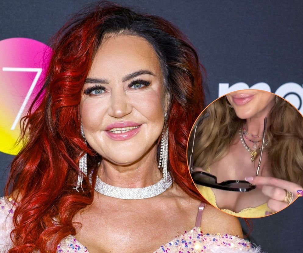 Agnieszka Kotońska pokazała posiniaczoną twarz po operacji. Szokujące wyznanie gwiazdy Gogglebox