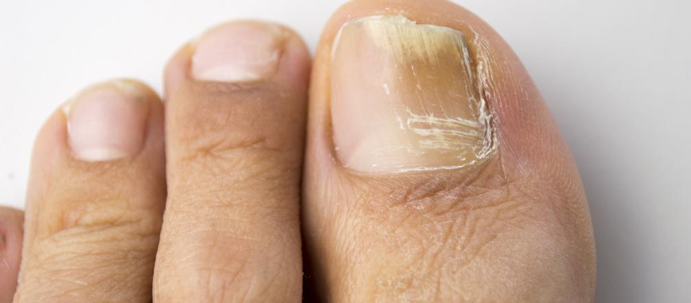 Paznokcie zaatakowane grzybicą