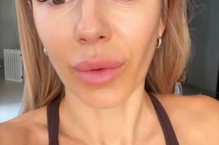 Doda pokazała bliznę po wycięciu czerniaka