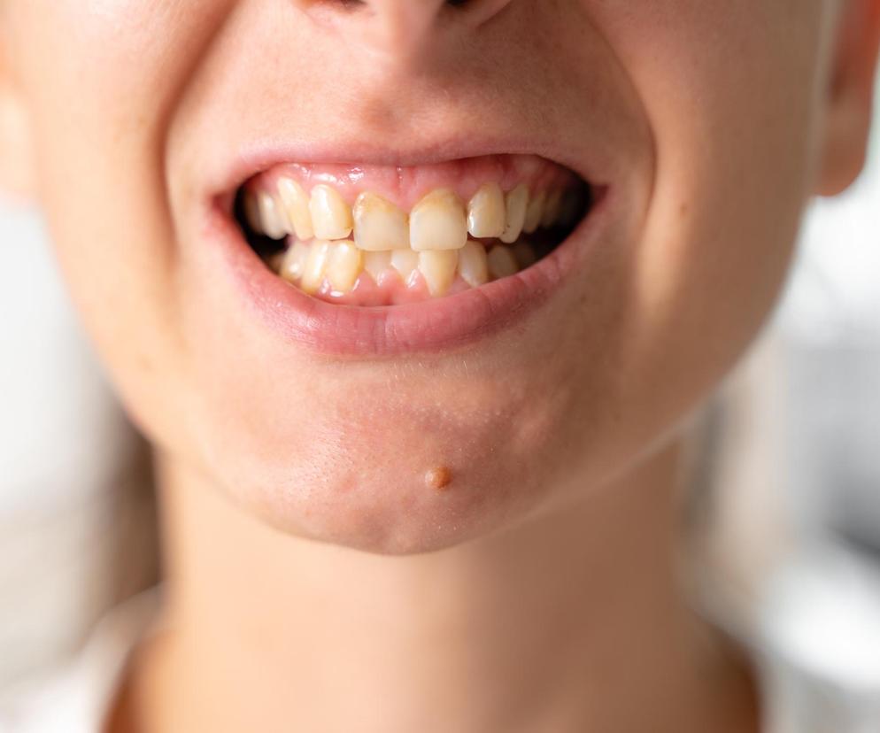 Po tych lekach zęby stają się żółte. Zwróć uwagę na popularne tabletki