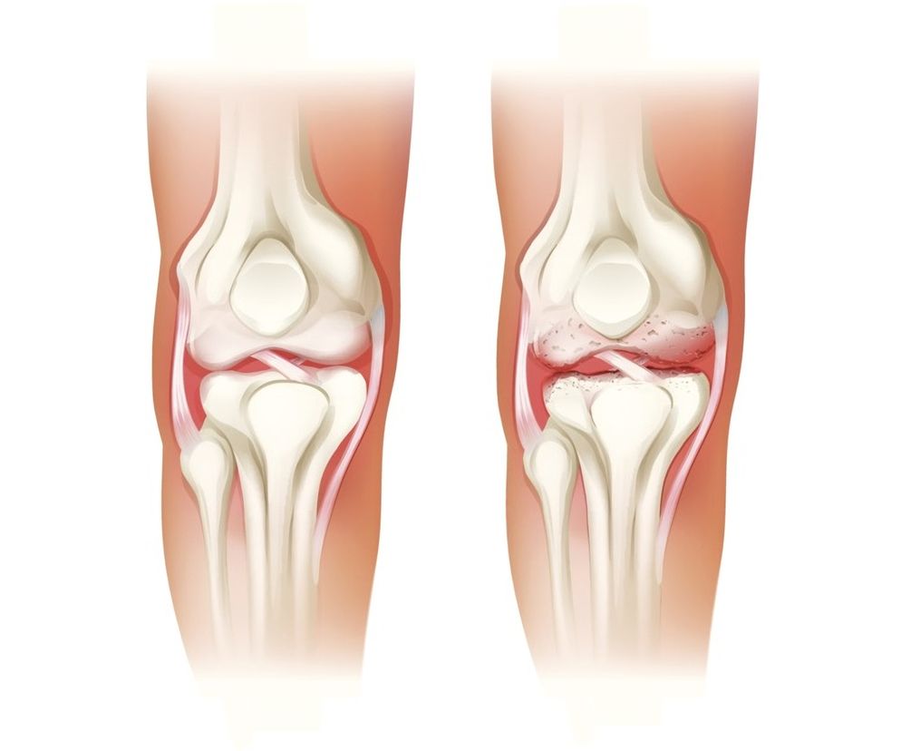 Zapalenie kaletki maziowej  utrudnia ruch ścięgien i mięśni. Jakie są  przyczyny  i  objawy  zapalenia kaletki maziowej i na czym polega  leczenie  tego schorzenia.