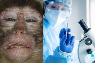 Małpia ospa atakuje! Jak ją leczyć? Naukowcy ujawnili nazwę leku