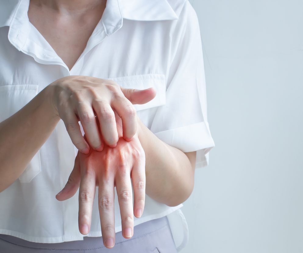 Świerzb - przyczyny, objawy i leczenie