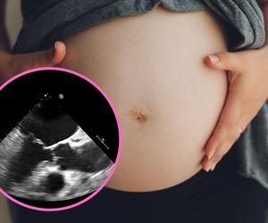 Ta ciąża zaskoczyła lekarzy! Urodzi... dwie pary bliźniąt na raz