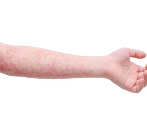 Zespół Stevensa-Johnsona: przyczyny, objawy, leczenie