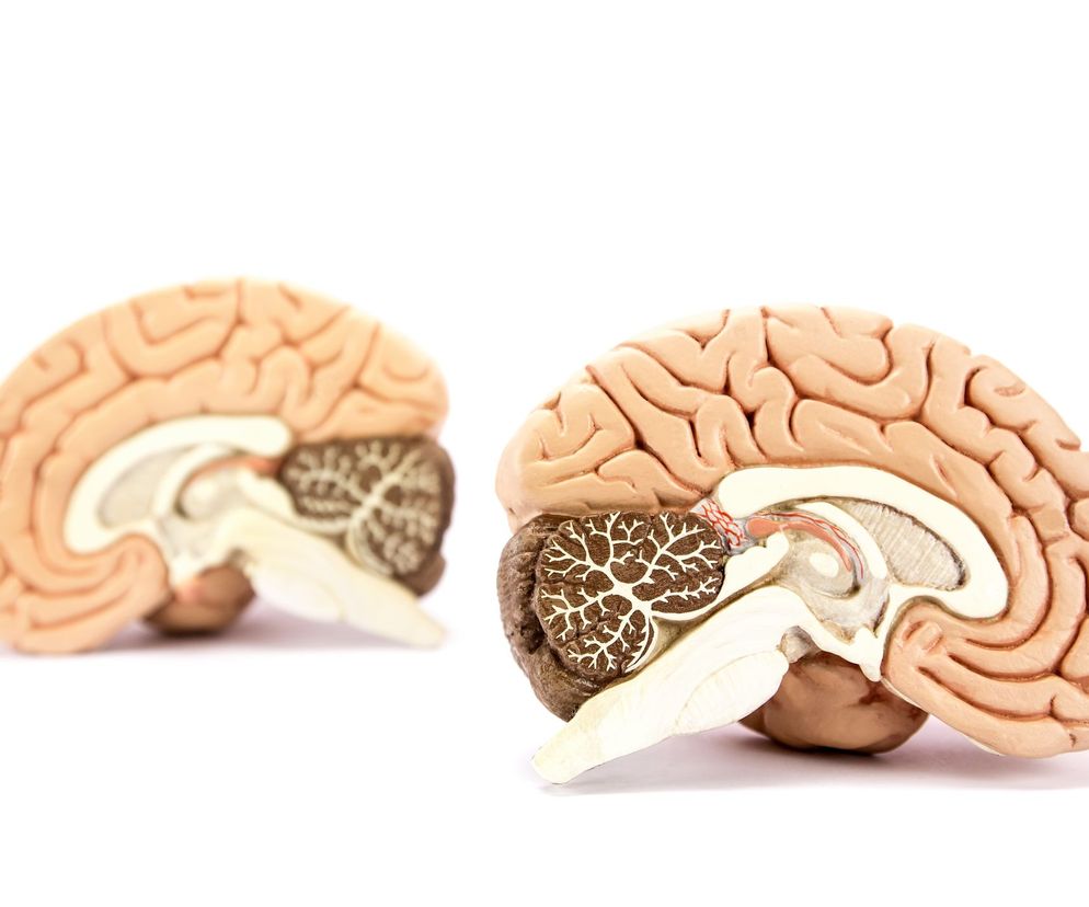 Guzy móżdżku należą do grupy nowotworów ośrodkowego układu nerwowego.