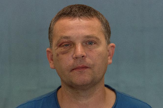 Wydrukowali mu nowe kości twarzy