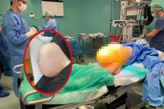 Gigantyczny guz jajnika ważył 20 kg! Lekarze ze Świdnicy usunęli go 38-letniej pacjentce