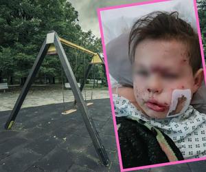 Zabawa w parku mogła skończyć się tragicznie. Ojciec chłopca pokazał drastyczne zdjęcia