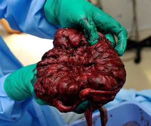 Jedzenie łożyska po porodzie