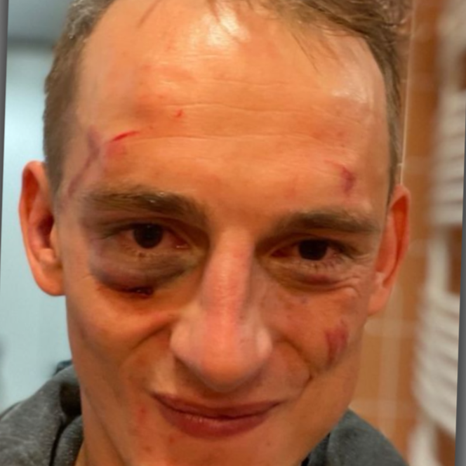 Jaś Kapela pokazał zmasakrowaną twarz po PRIME MMA 2