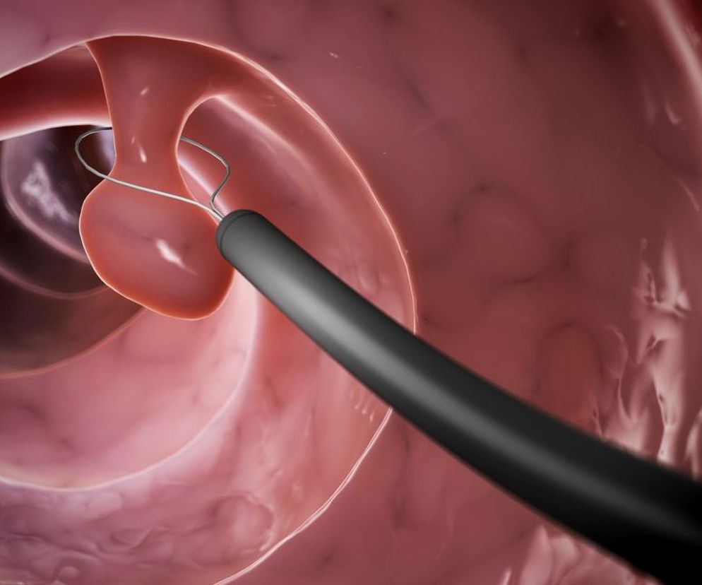 Polipy w jelitach i w żołądku  wyglądem przypominają małe baloniki. Powstają w wyniku uwypuklenia śluzówki do światła jelita i przez długi czas moga nie dawac żadnych objawów.