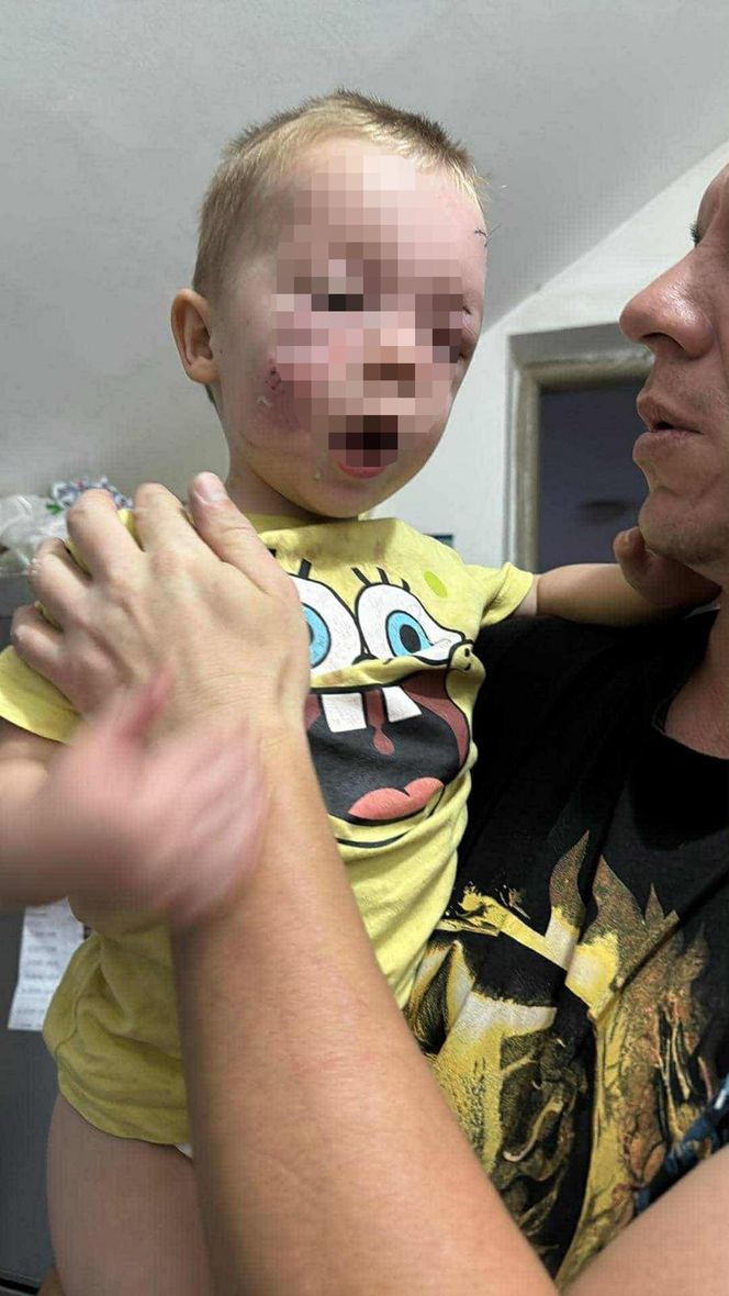 Pies pogryzł 3-latka na przystanku