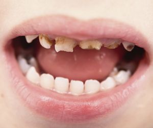 Próchnica zębów mlecznych: przyczyny, objawy, leczenie próchnicy u dwu-, trzylatka