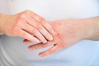 Domowe sposoby łagodzenia skutków atopowego zapalenia skóry