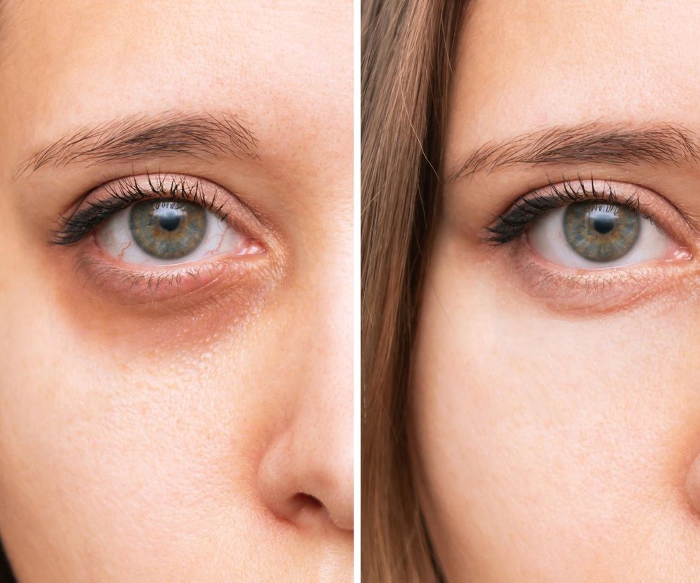 Tania maść z apteki czyni cuda dla skóry pod oczami. Efekty cię zachwycą