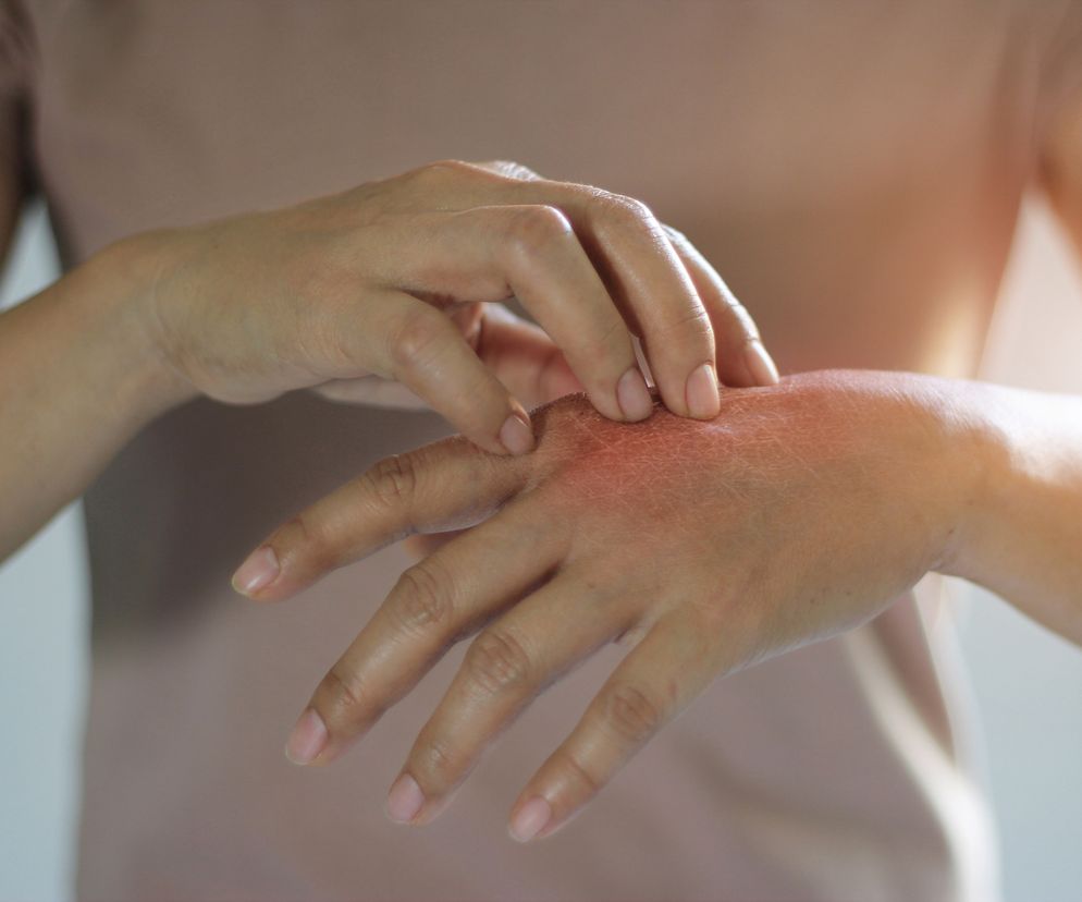 Kobieta drapie się po ręce.