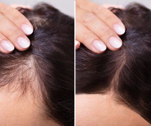 Tych witamin brakuje, kiedy wypadają ci włosy. Zrób badania krwi