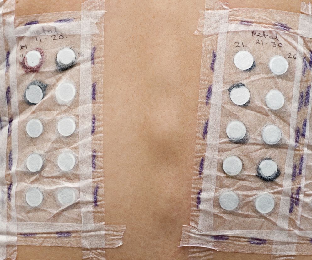 Na czym polegają TESTY ALERGICZNE