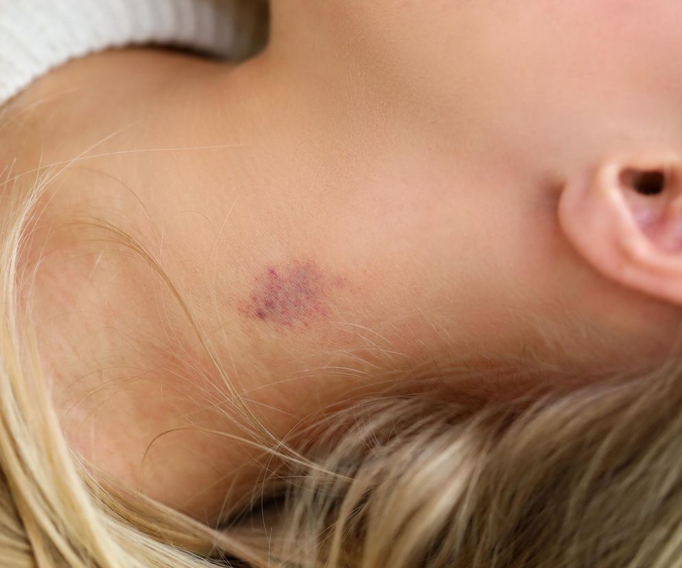 Tak szybko i skutecznie pozbędziesz się malinki. Lekarz zdradza: wystarczą dwa kroki