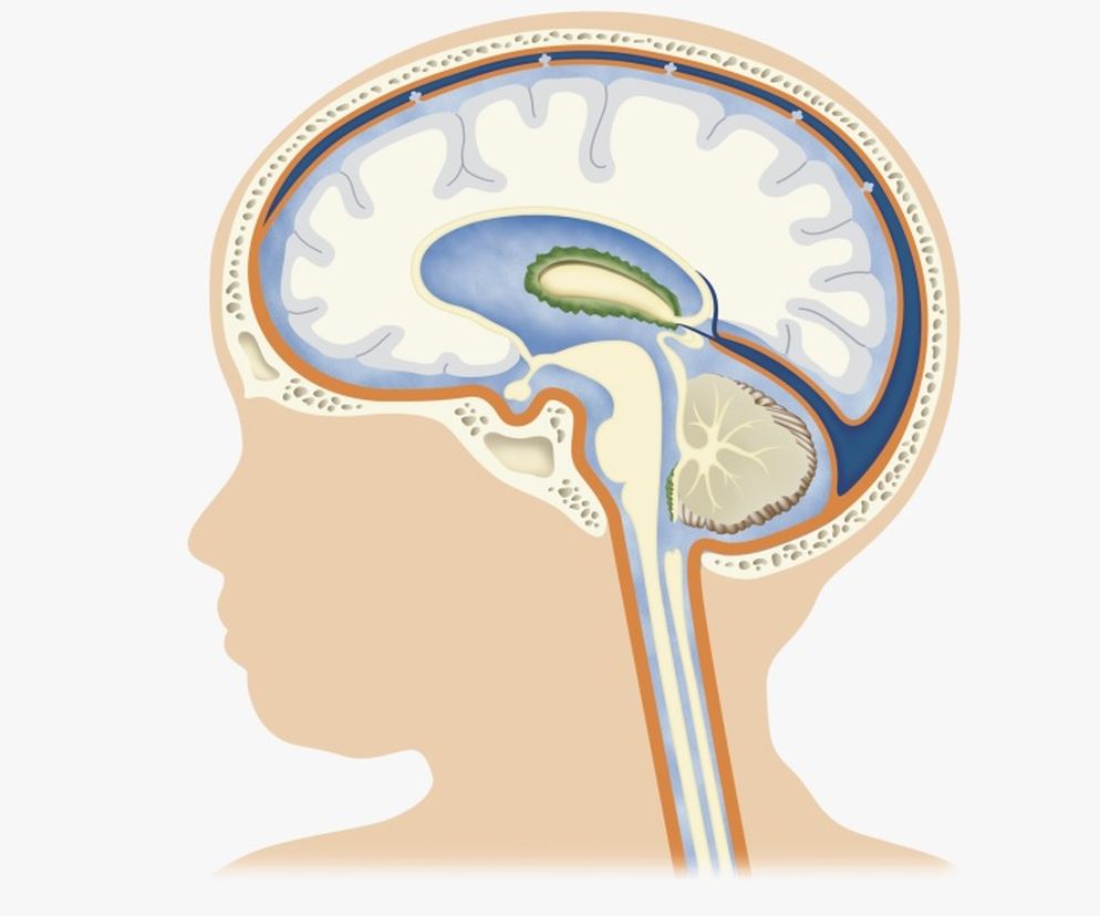 Wodogłowie   u płodu  może doprowadzić do jego obumarcia, a  u niemowląt  - do zahamowania rozwoju. Jakie są  przyczyny  i  objawy wodogłowia? Na czym polega jego  leczenie ?