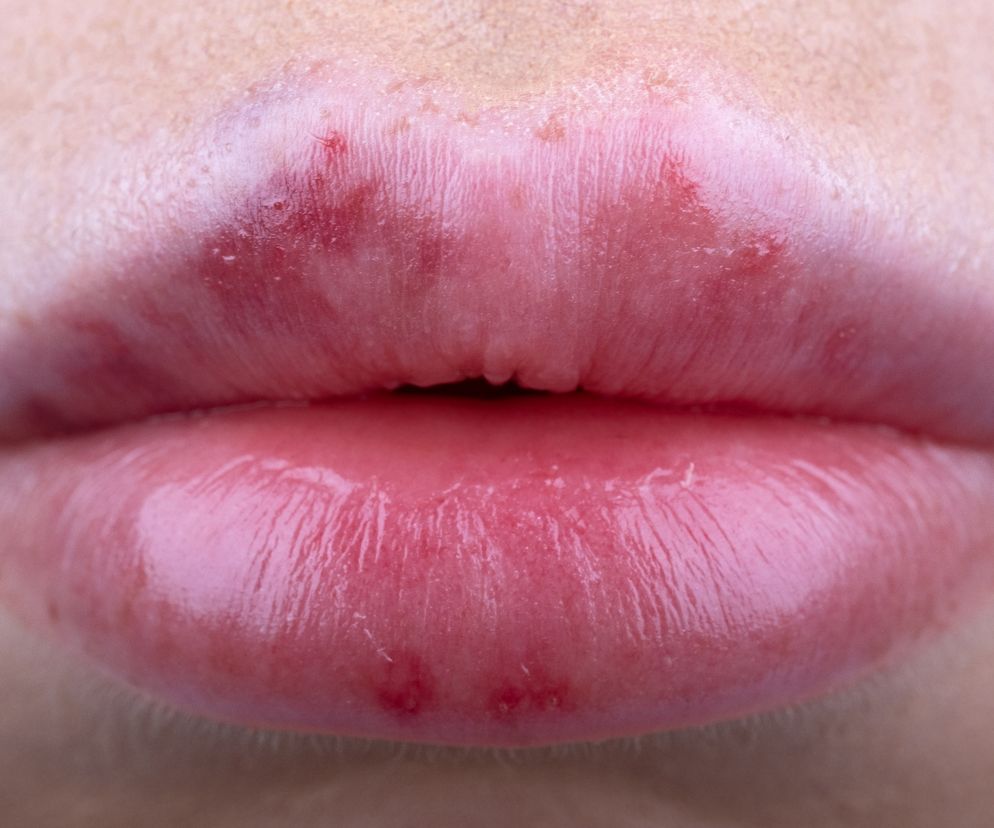 Botoks ratunkiem dla życia i zdrowia? Infiltruje komórki mózgowe