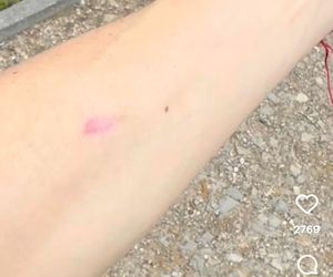 Doda pokazała bliznę po wycięciu czerniaka