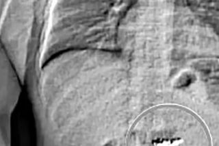 Ukradł diamentowe kolczyki i je połknął. Policja w końcu je odzyskała