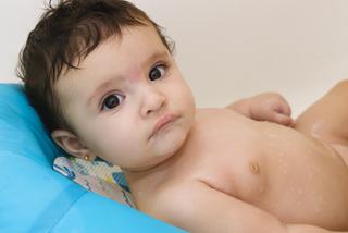 Uszczypnięcie bociana najczęściej jest zlokalizowane na karku lub między brwiami dziecka