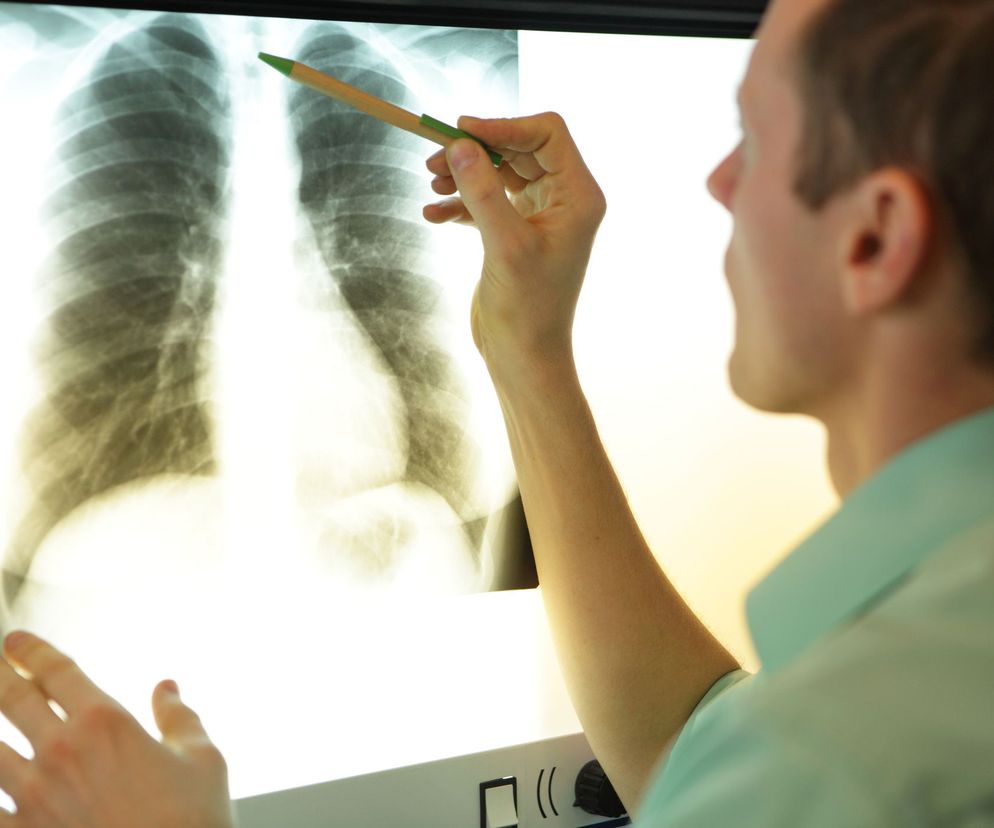 Zespół żebra szyjnego (zespół Naffzigera) wynika z obecności dodatkowego żebra w okolicy szyi, mniej lub bardziej wykształconego.