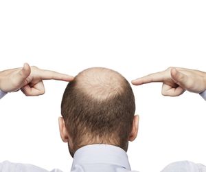 Pięć sposobów na ŁYSIENIE u mężczyzn