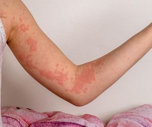  Jest jak tykająca bomba. Jej objawy można łatwo pomylić z alergią pokarmową | #MEDetektyw