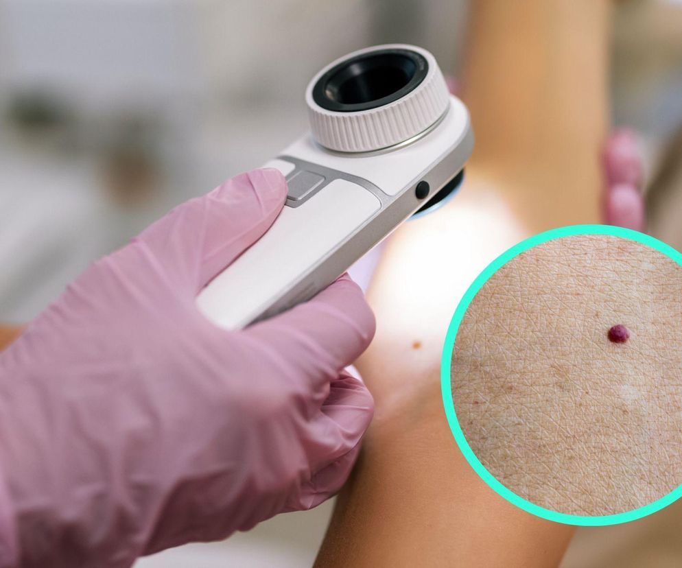 Czerwone plamki na skórze budzą lęk. Dermatolożka tłumaczy, kiedy jest uzasadniony