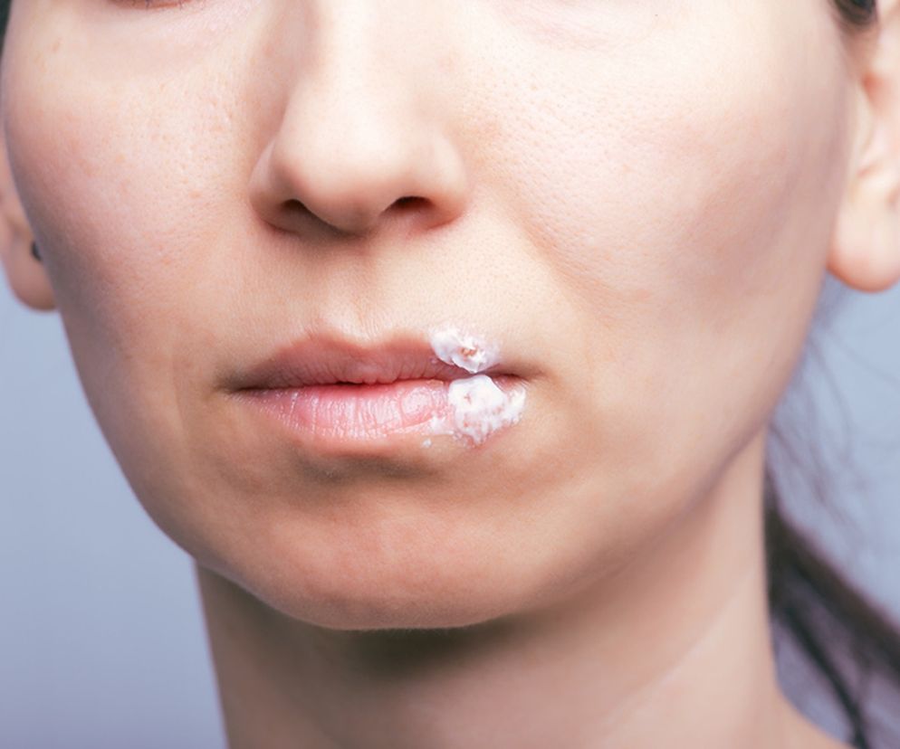 Soda oczyszczona na opryszczkę – czy działa?