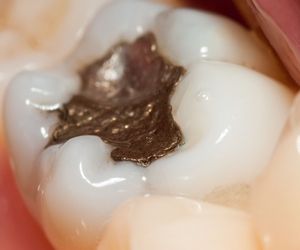 Czy plomby amalgamatowe są szkodliwe? Czy trzeba je wymieniać?