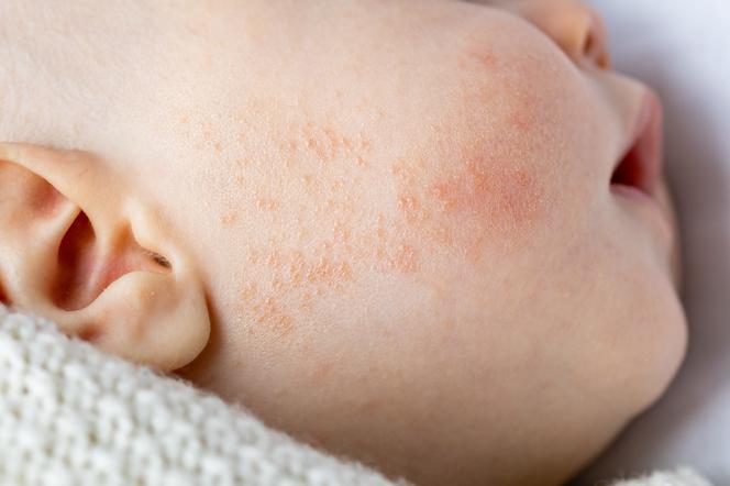 Wysypka alergiczna - jak wygląda i jak ją rozpoznać u dziecka?